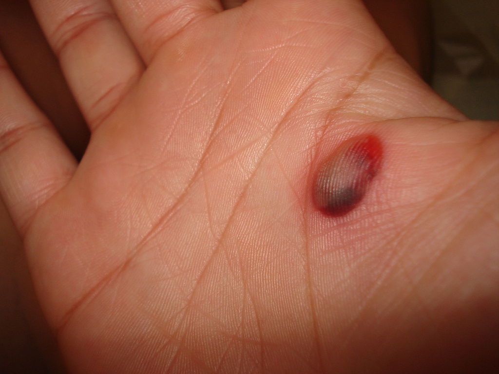 1024px-Blood_blister_close-up_2_by_Esinam